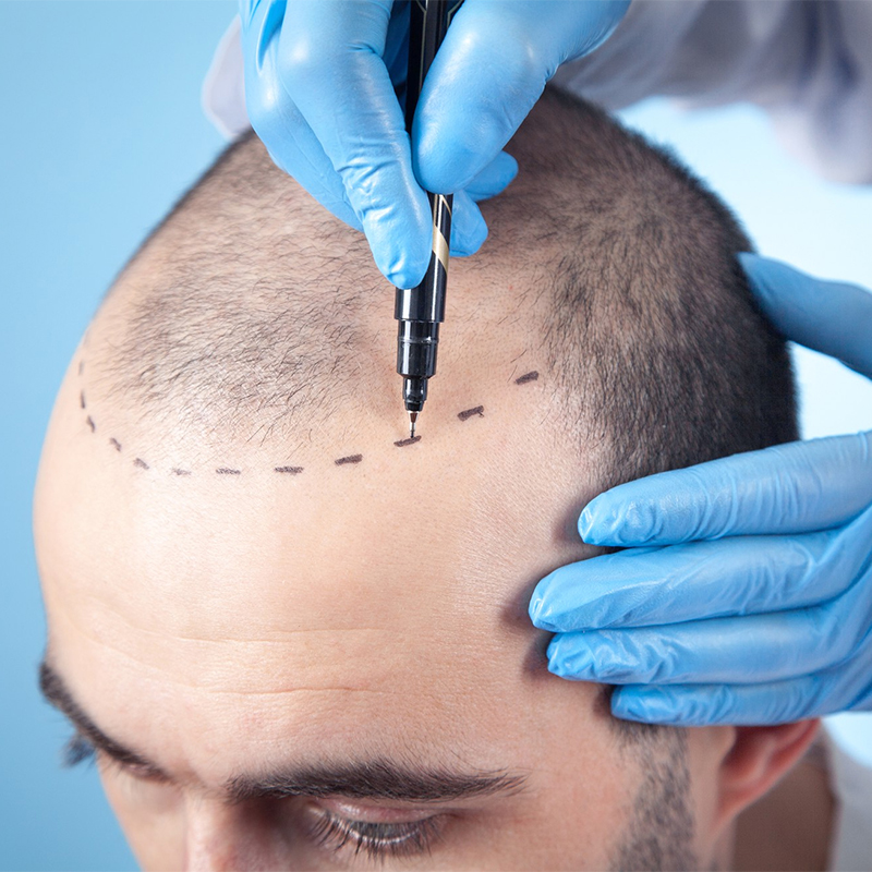  hair transplant without shaving cost Turkey